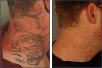 Como remover tatuagem a laser